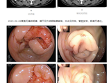 肠癌错失手术时机，转化治疗化腐朽为神奇