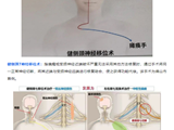 佛山市首例健侧颈7神经移位术！给神经做“移花接木”，唤醒偏瘫的左肢