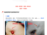 对抗女性健康“第一杀手”，专家指出：关键在于筛查！