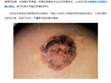 一女子乳头反复瘙痒、渗液，一查竟是乳腺癌！