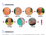 告别蚯蚓腿，和伤口说拜拜