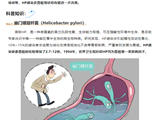 南方七院陈羽教授参编诺贝尔奖得主巴里·马歇尔教授权威书籍揭示内镜下快速诊断幽门螺杆菌的新技术