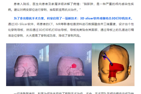 当脑脓肿遇上新技术：精准！3D打印解决脑部大麻烦