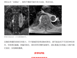 突破手术“禁区”，南方七院六小时完成多节段胸椎肿瘤整块切除